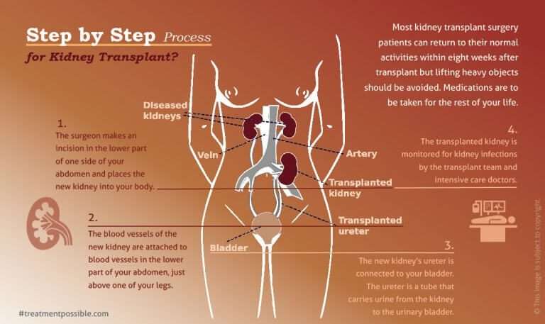 This infographic shows the the step by step procedure used for kidney transplant and a diagram of internal organs