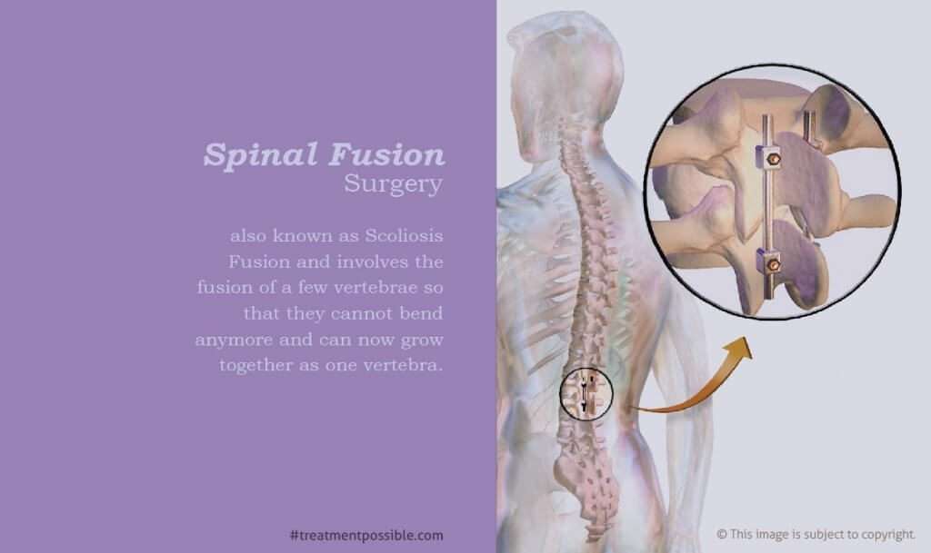 A diagram which shows how the spinal fusion surgery is performed which involves fusion of few vertebrae by using rods and wires to join them so that they grow as one vertebra.