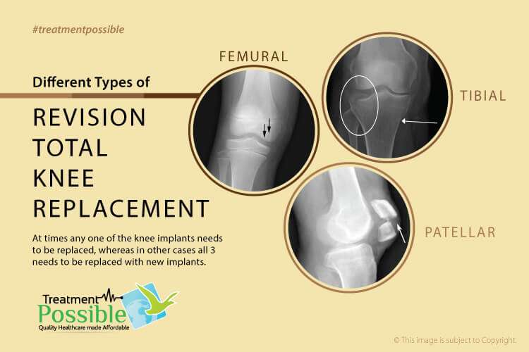 Infographic on the three types of total knee replacement surgery which are Femural, Tibial and Patellar