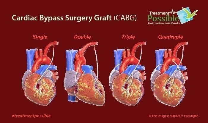 there are 4 types of techniques used for heart bypass surgery that is single, double, triple and quadruple