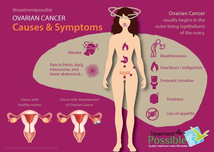 Infographic showing the different symptoms which indicate ovarian cancer
