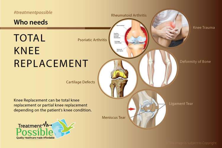 An infographic showing various problems which may require Total knee replacement surgery