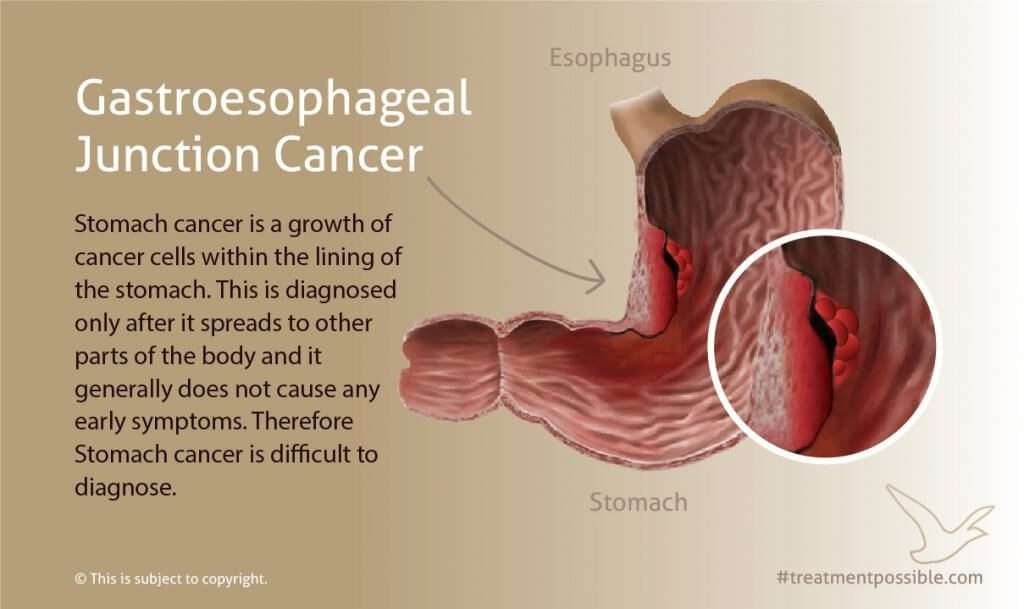an infographic showing gastroesophageal stomach cancer