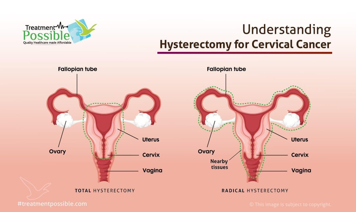 Cervical Cancer Treatment Treatment Possible 