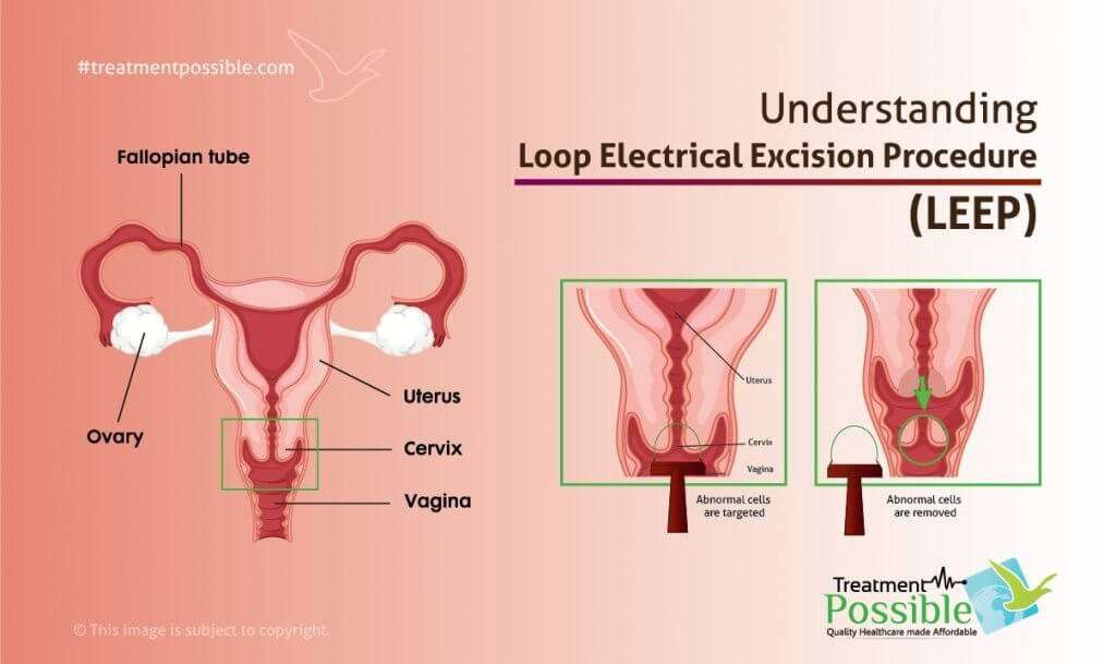 An Infographic Explaining what is Loop electrosurgical excision procedure (LEEP) for cervical cancer
