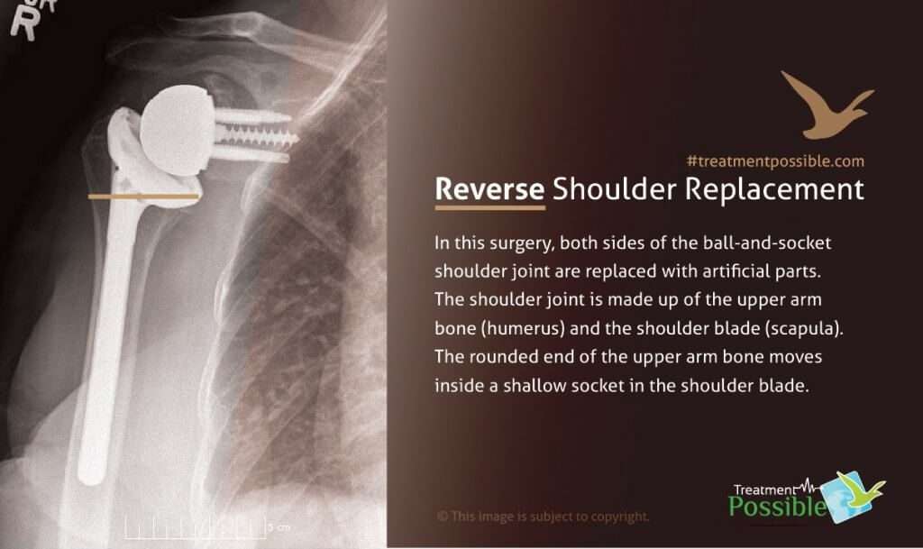 Reverse Shoulder Replacement in India