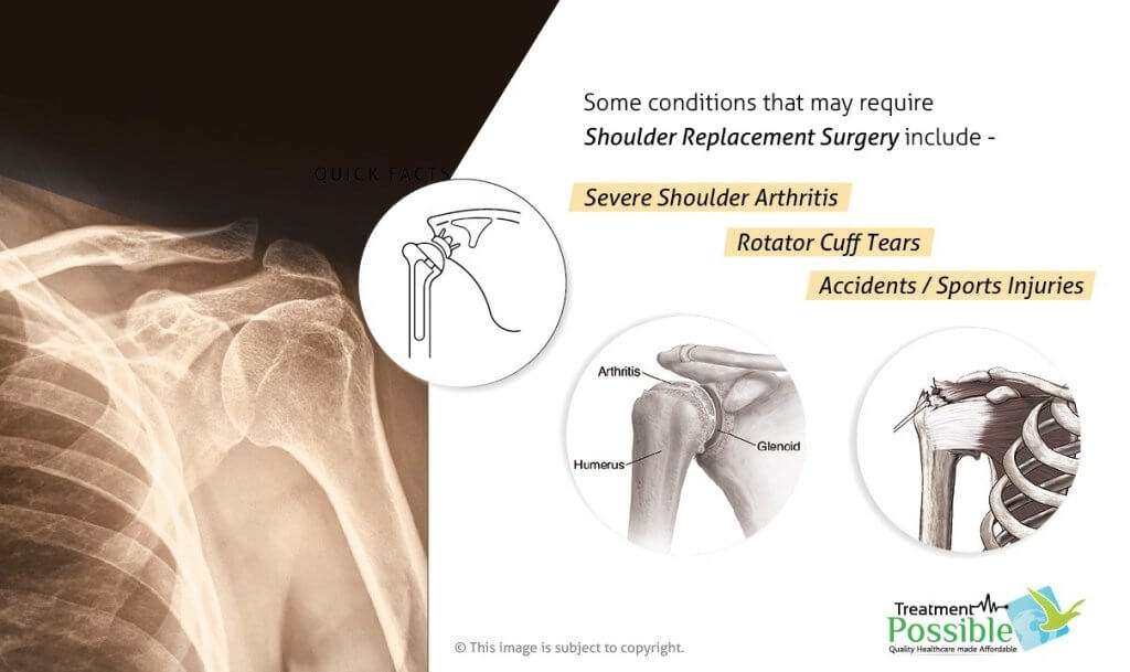When do you need to undergo shoulder replacement surgery?