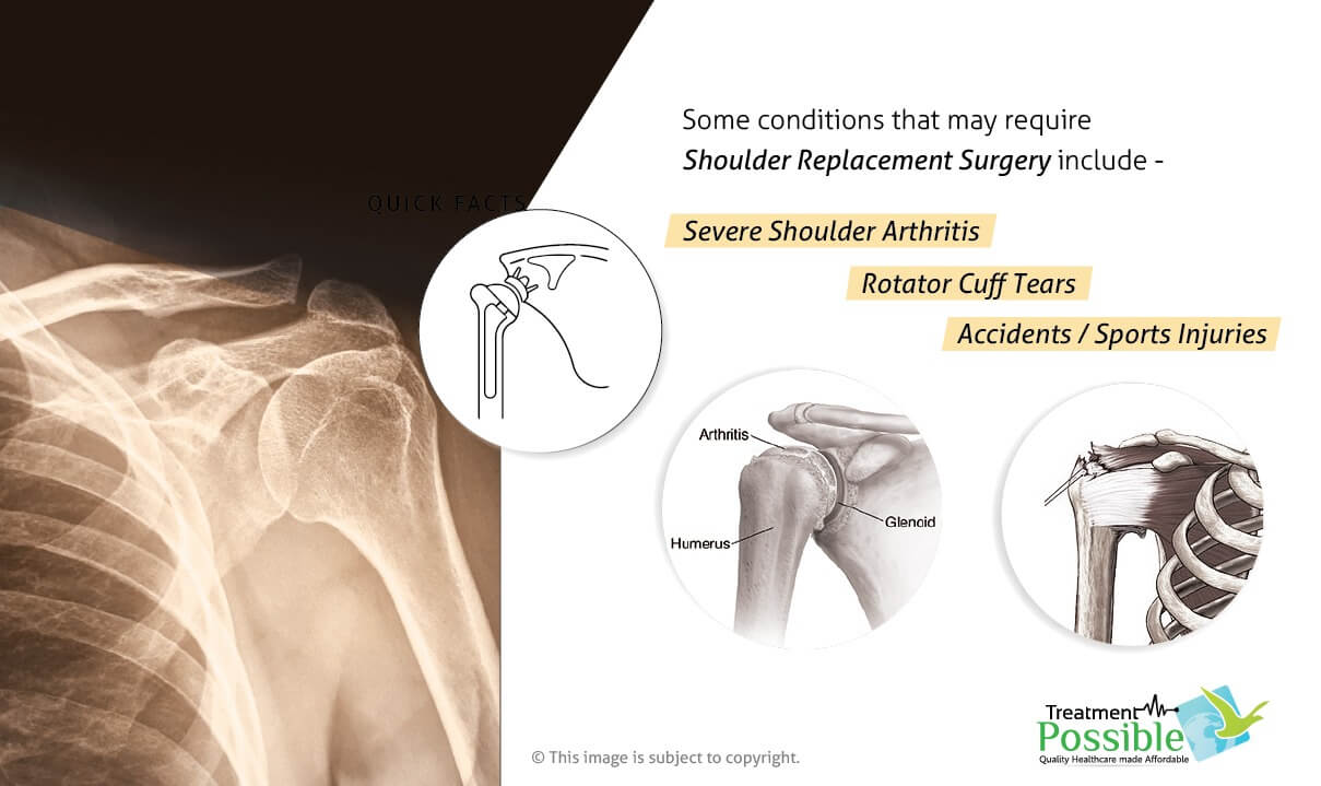 Plan Your Shoulder Replacement Surgery in India | Treatment Possible