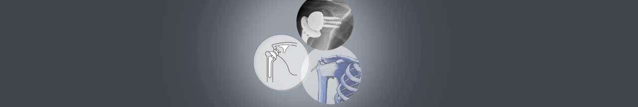 Shoulder replacement surgery in India