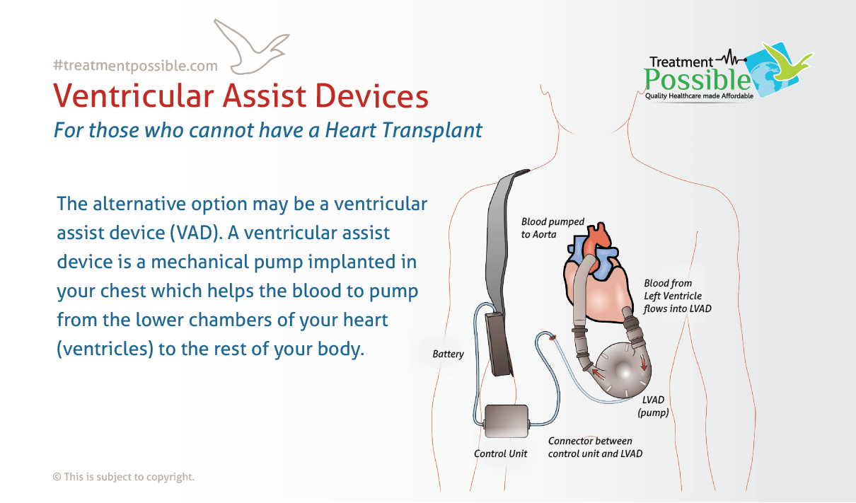 An Infographic explaining what is a ventricular assist device (VAD). Alternative of heart transplant.