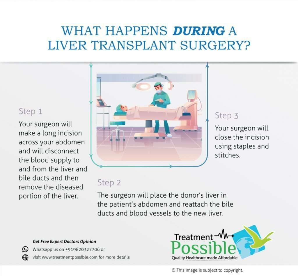 An infographic explaining how is liver transplant surgery performed.