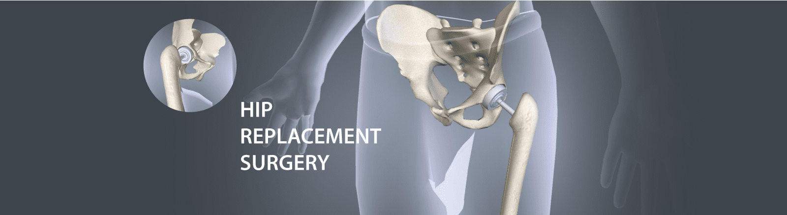 hip replacement surgery in India