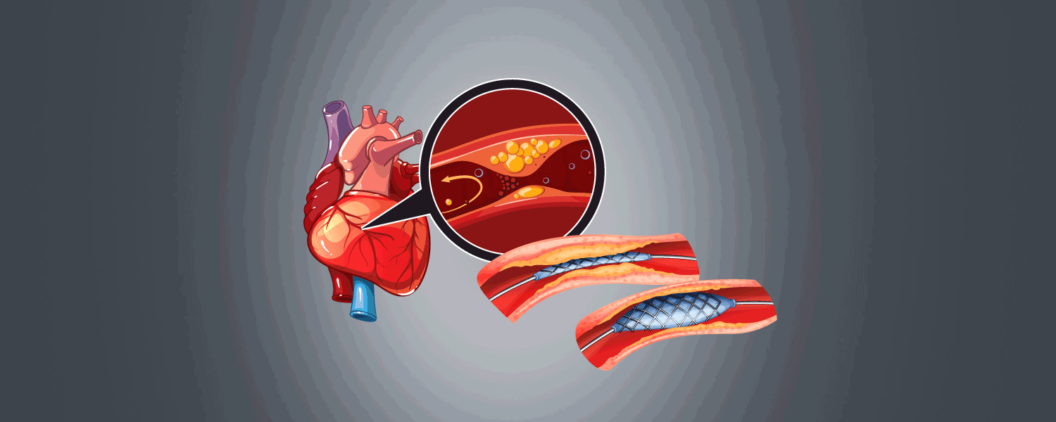 stent is inserted during Angioplasty