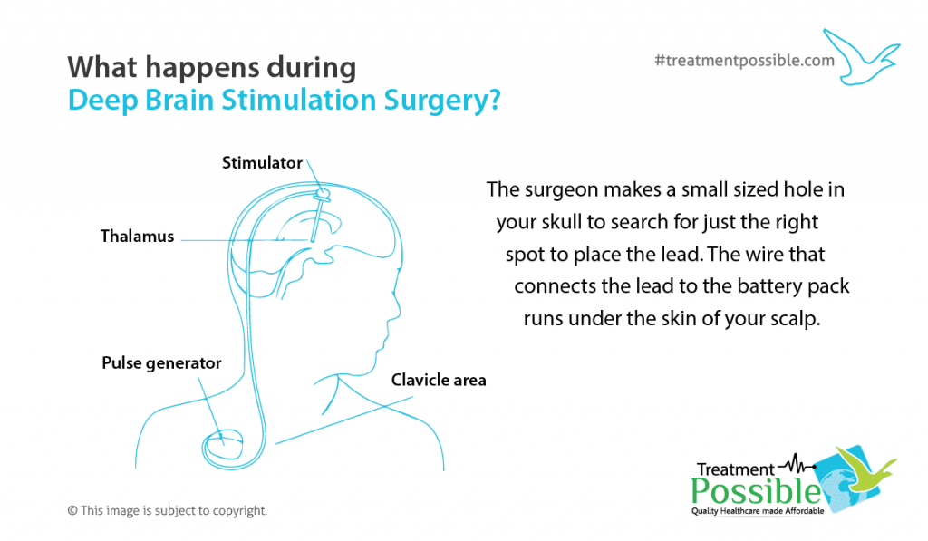 Deep brain stimulation surgery in India