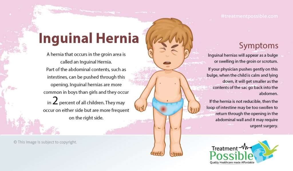 Symptoms of Inguinal hernia