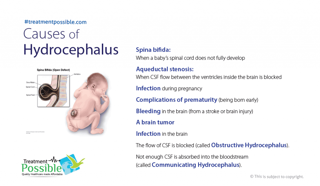 Causes of hydrocephalus in children