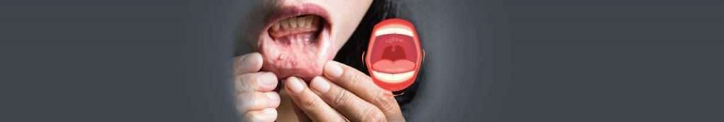 oral cancer treatment in india