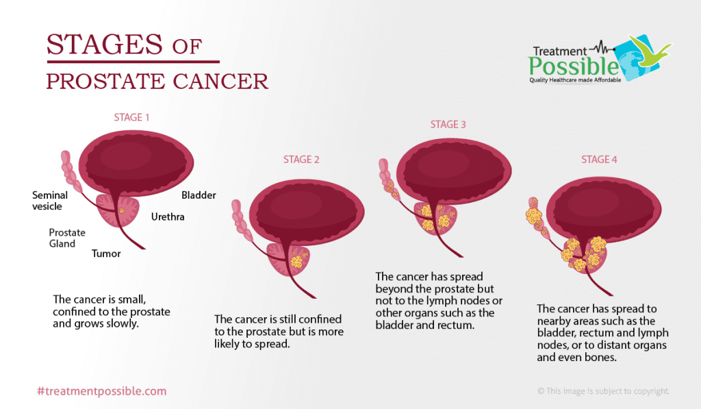 stages of prostate cancer