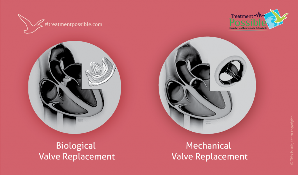 types of mitral valve replacement