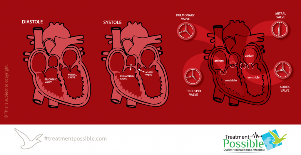 Mitral Valve Replacement in India